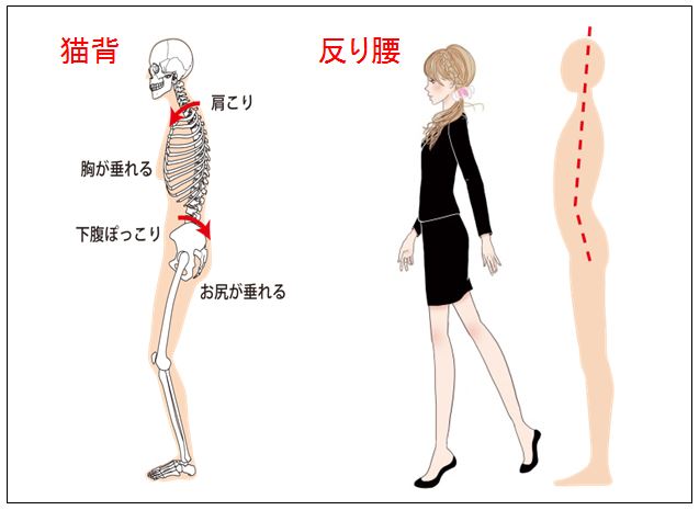 猫背、反り腰　ハイヒールの弊害