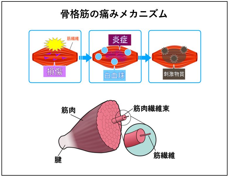 骨格筋の痛みメカニズム