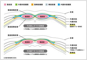 腹直筋は三つの腱膜（外腹斜筋、内腹斜筋、腹横筋）につつまれているが弓状線の上と下で異なる。