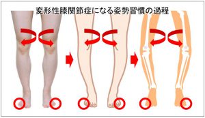 変形性膝関節症になる姿勢習慣の過程
